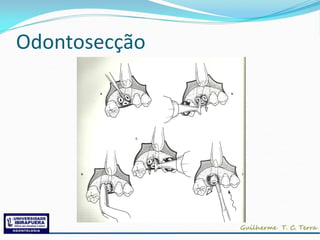 Odontosecção
 
