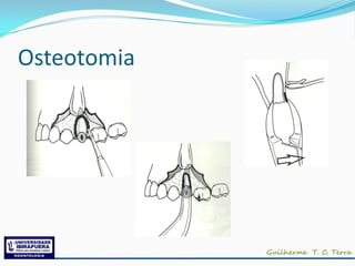 Osteotomia
 