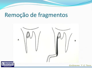 Remoção de fragmentos
 