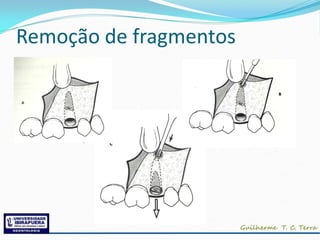 Remoção de fragmentos
 