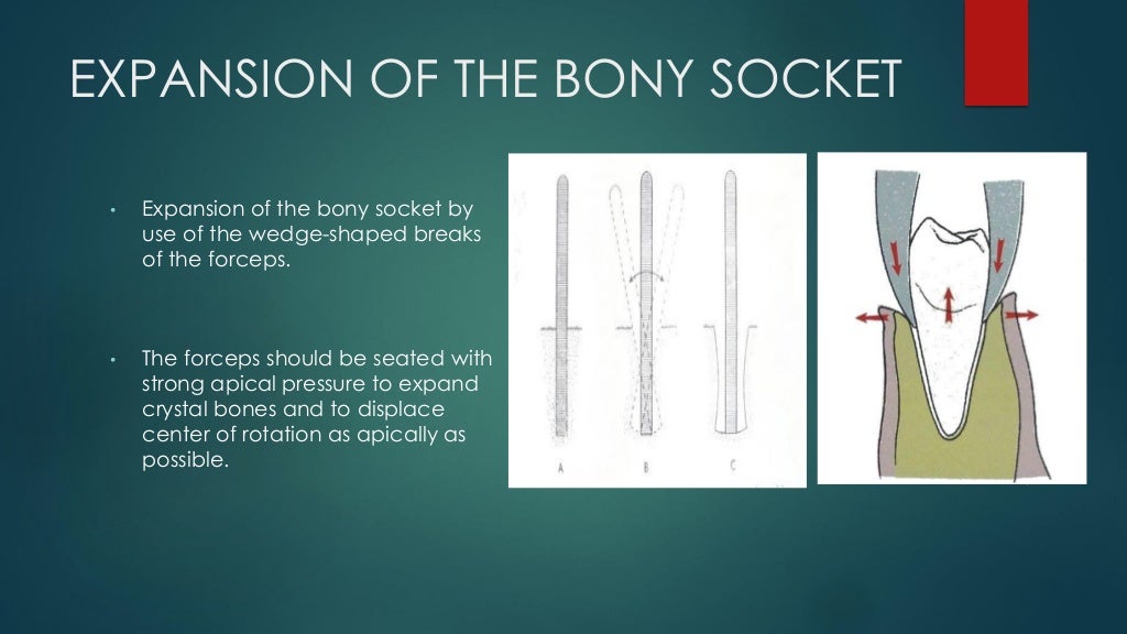 Exodontia Principles and Techniques