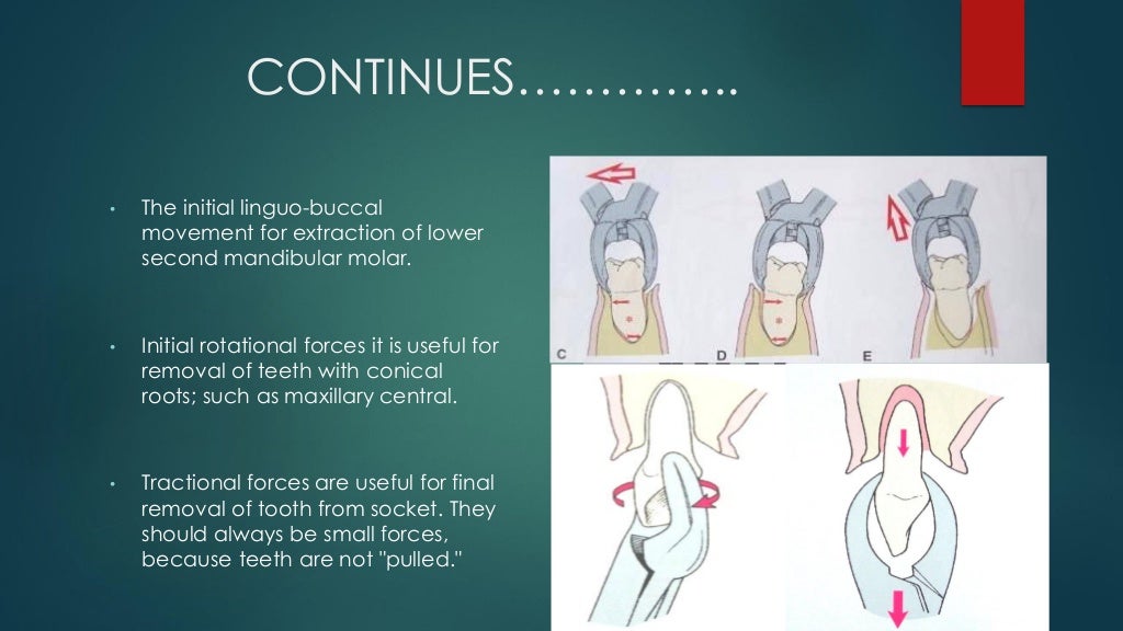 Exodontia Principles and Techniques