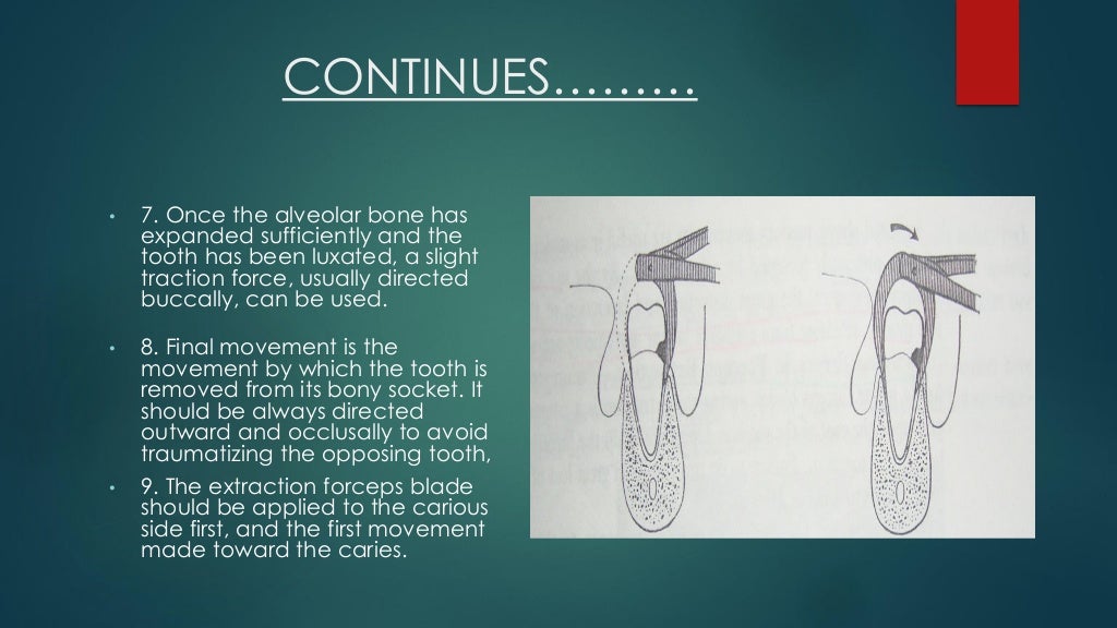 Exodontia Principles and Techniques