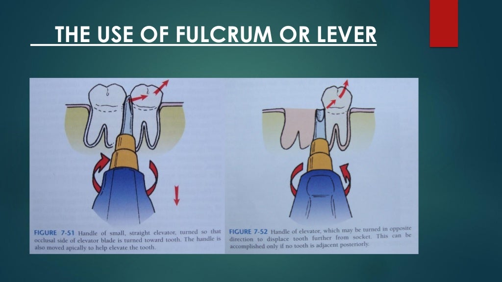 Exodontia Principles and Techniques