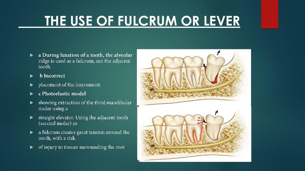Exodontia Principles and Techniques