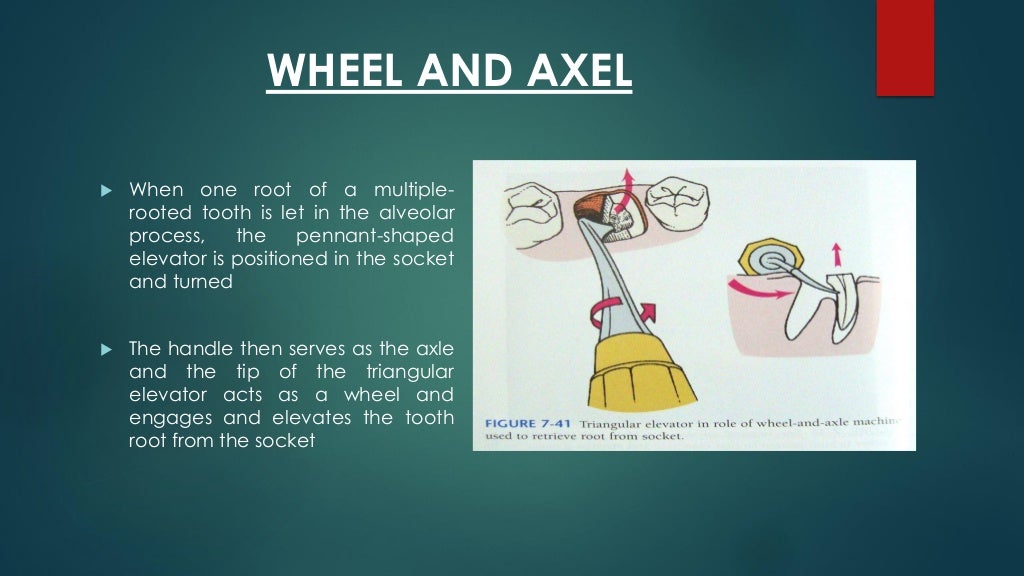 Exodontia Principles and Techniques