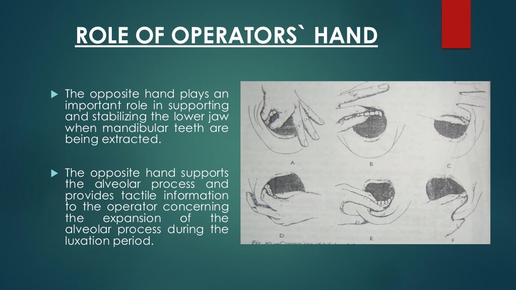 Exodontia Principles and Techniques