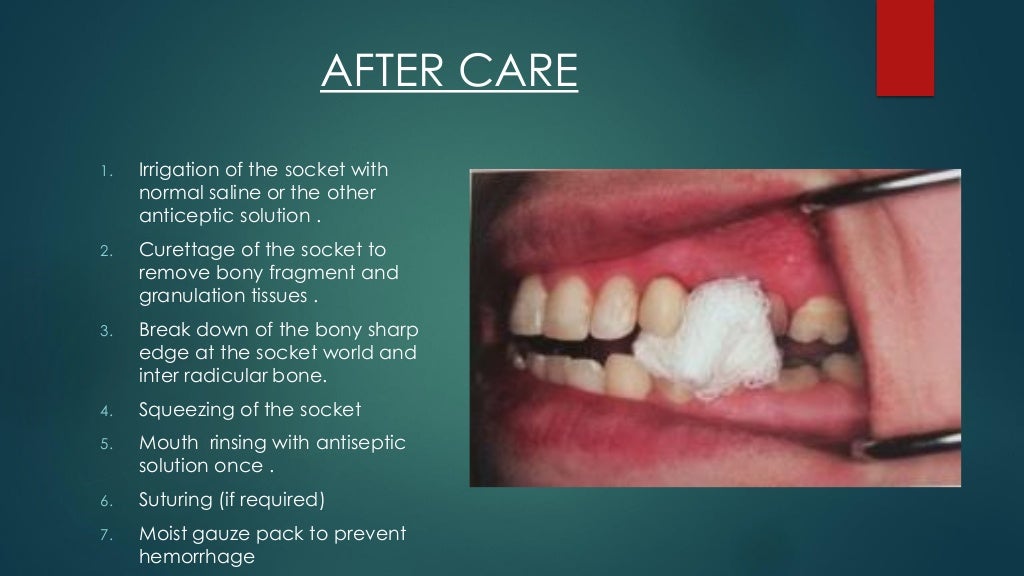 Exodontia Principles and Techniques