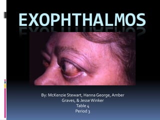 EXOPHTHALMOS


  By: McKenzie Stewart, Hanna George, Amber
           Graves, & Jesse Winker
                   Table 4
                   Period 3
 
