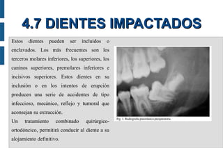 4.7 DIENTES IMPACTADOS
Estos

dientes

pueden

ser

incluidos

o

enclavados. Los más frecuentes son los
terceros molares inferiores, los superiores, los
caninos superiores, premolares inferiores e
incisivos superiores. Estos dientes en su
inclusión o en los intentos de erupción
producen una serie de accidentes de tipo
infeccioso, mecánico, reflejo y tumoral que
aconsejan su extracción.
Un

tratamiento

combinado

quirúrgico-

ortodóncico, permitirá conducir al diente a su
alojamiento definitivo.

 