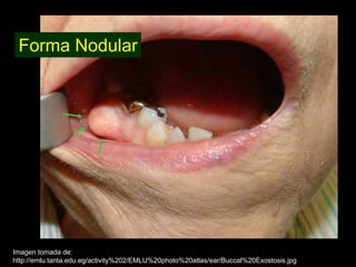 Forma Nodular




Imagen tomada de:
http://emlu.tanta.edu.eg/activity%202/EMLU%20photo%20atlas/ear/Buccal%20Exostosis.jpg
 