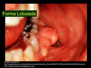 Forma Lobulada




Imagen tomada de:
http://student.ahc.umn.edu/dental/coursearchives/2yr_Spring/DENT6316/Study%20Aids/50%20Lesions
%20-%20For%20The%20Beginner.ppt
 