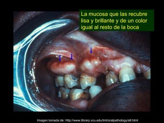 La mucosa que las recubre
                              lisa y brillante y de un color
                              igual al resto de la boca




Imagen tomada de: http://www.library.vcu.edu/tml/oralpathology/all.html
 