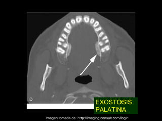 EXOSTOSIS
                              PALATINA
Imagen tomada de: http://imaging.consult.com/login
 