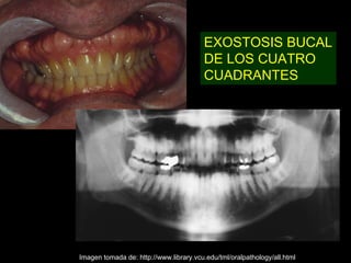 EXOSTOSIS BUCAL
                                        DE LOS CUATRO
                                        CUADRANTES




Imagen tomada de: http://www.library.vcu.edu/tml/oralpathology/all.html
 