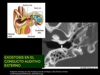 EXOSTOSIS EN EL
CONDUCTO AUDITIVO
EXTERNO
  Imágenes tomadas de: http://imaging.consult.com/login y http://5ones.com/wp-
  content/uploads/2009/02/ear_illustration2.jpg
 