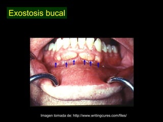 Exostosis bucal




        Imagen tomada de: http://www.writingcures.com/files/
 