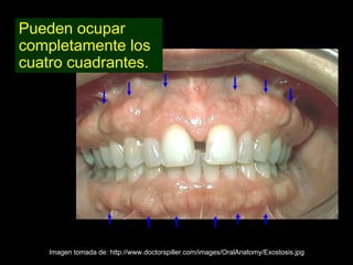 Pueden ocupar
completamente los
cuatro cuadrantes.




    Imagen tomada de: http://www.doctorspiller.com/images/OralAnatomy/Exostosis.jpg
 