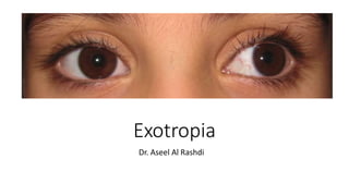 Exotropia
Dr. Aseel Al Rashdi
 