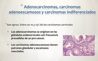 * Adenocarcinomas, carcinomas
   adenoescamosos y carcinomas indiferenciados

* Son aprox. Entre un 10 y 25% de los carcinomas cervicales

  • Los adenocarcinomas se originan en las
    glándulas endocervicales con frecuencia
    precedidos de un pre-cancer.

  • Los carcinomas adenoescamosos tienen
    patrones glandular y escamosos
    mezclados.
 