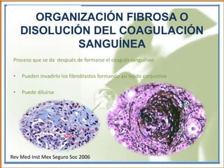 ORGANIZACIÓN FIBROSA O
DISOLUCIÓN DEL COAGULACIÓN
SANGUÍNEA
Proceso que se da después de formarse el coagulo sanguíneo
• Pueden invadirlo los fibroblastos formando así tejido conjuntivo
• Puede diluirse
Rev Med Inst Mex Seguro Soc 2006
 