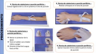 PROCEDIMIENTO
8. Técnica de cateterismo o punción periférica .-
Colocar ligadura de 6 a 10 cm próxima al sitio de punción
8. Técnica de cateterismo o punción periférica .-
Realizar antisepsia en el área de punción
8. Técnica de cateterismo o
punción periférica .-
 Retirar el protector de la
aguja
 Tome el catéter con el dedo
índice y pulgar
 Oriente el bisel de la aguja
hacia arriba
8. Técnica de cateterismo o punción periférica .-
Ejercer tracción minina sobre la piel en el área
de punción
 