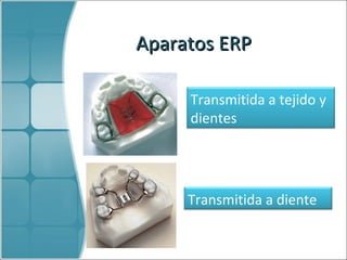 Aparatos  ERP Transmitida a tejido y dientes Transmitida a diente 