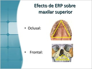 Efecto  de ERP sobre  maxilar superior Oclusal: Frontal: 
