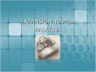 EXPANSIÓN  RAPIDA PALATINA 