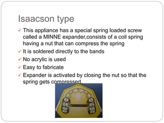 Isaacson type
 This appliance has a special spring loaded screw
called a MINNE expander,consists of a coil spring
having ...