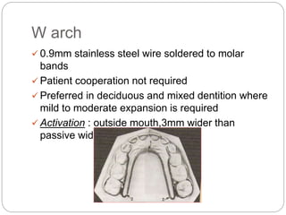 W arch
 0.9mm stainless steel wire soldered to molar
bands
 Patient cooperation not required
 Preferred in deciduous an...