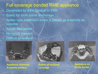 Expansion in orthodontics.pptxx final ppt | PPT