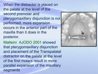 Conclusion
• Maxillary arch constriction or maxillary width
deficiency associated with a high palatal vault is
generally t...