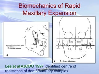 Biomechanics of Rapid
Maxillary Expansion
Lee et al AJODO 1997 identified centre of
resistance of dentomaxillary complex
w...