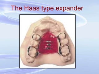 The Haas type expander
 