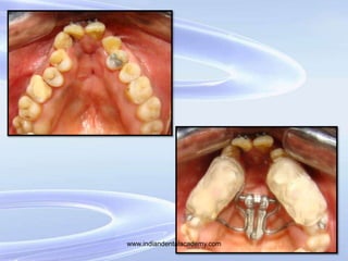 Nickel palatal Expander
• It was developed by Dr Wendell Arndt (Kansas) in
1993, in order to overcome the limitations of
c...