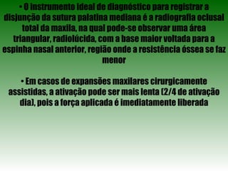 •  O instrumento ideal de diagnóstico para registrar a disjunção da sutura palatina mediana é a radiografia oclusal total da maxila, na qual pode-se observar uma área triangular, radiolúcida, com a base maior voltada para a espinha nasal anterior, região onde a resistência óssea se faz menor •  Em casos de expansões maxilares cirurgicamente assistidas, a ativação pode ser mais lenta (2/4 de ativação dia), pois a força aplicada é imediatamente liberada 