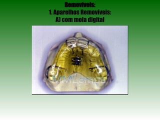 Removíveis: 1. Aparelhos Removíveis: A) com mola digital 