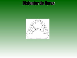 Disjuntor de Hyrax 