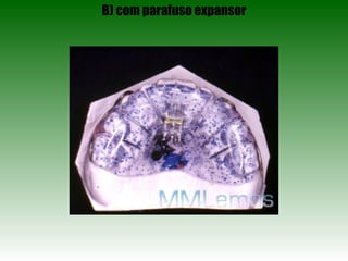 B) com parafuso expansor 