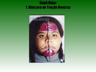 Semi-fixos: 1. Máscara de Tração Reversa 