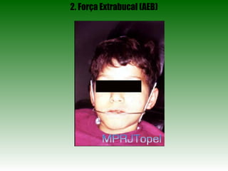 2. Força Extrabucal (AEB) 