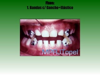 Fixos: 1. Bandas c/ Gancho+Elástico 