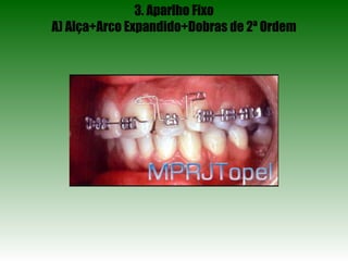 3. Aparlho Fixo A) Alça+Arco Expandido+Dobras de 2ª Ordem 