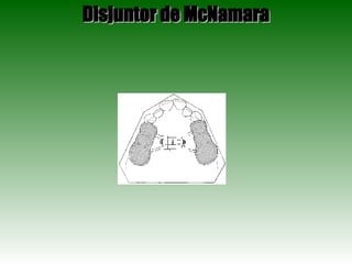 Disjuntor de McNamara 