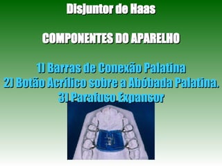 Disjuntor de Haas COMPONENTES DO APARELHO 1) Barras de Conexão Palatina 2) Botão Acrílico sobre a Abóbada Palatina. 3) Parafuso Expansor 