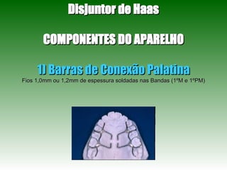 Disjuntor de Haas COMPONENTES DO APARELHO 1) Barras de Conexão Palatina Fios 1,0mm ou 1,2mm de espessura soldadas nas Bandas (1ºM e 1ºPM) 
