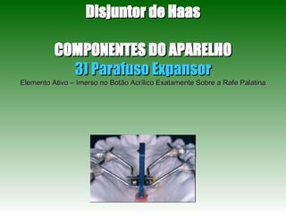 Disjuntor de Haas COMPONENTES DO APARELHO 3) Parafuso Expansor Elemento Ativo – Imerso no Botão Acrílico Exatamente Sobre a Rafe Palatina 