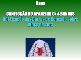 Haas CONFECÇÃO DO APARELHO C/ 4 BANDAS 06) Fixação das Barras de Conexão sobre Bloco de Cera 