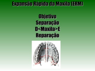 Expansão Rápida da Maxila (ERM) Objetivo Separação D<Maxila>E Reparação 